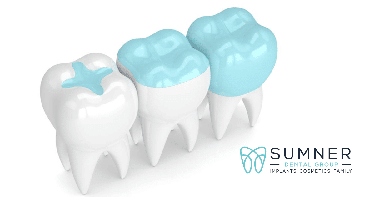 Dentist in Gallatin, Gallatin Dentist, Dental Sealant and Filling, Sumner Dental Group in Gallatin, TN, Best dentist in Gallatin