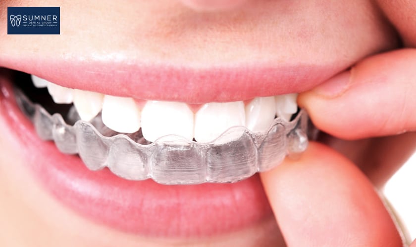 The Impact of Invisalign