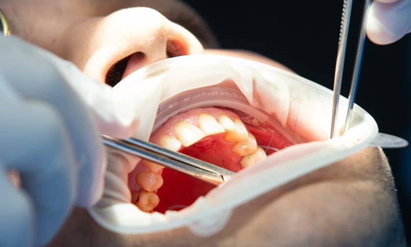 tooth extractions in Gallatin, TN