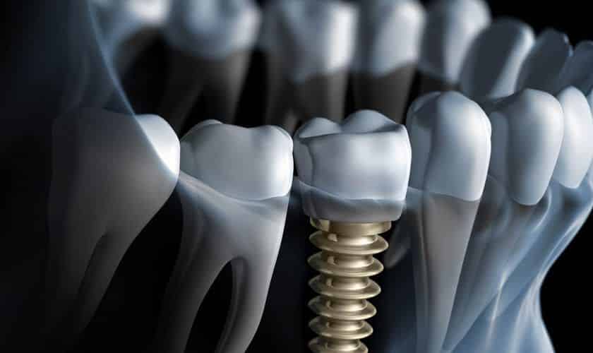 Dental Implants in Gallatin, TN