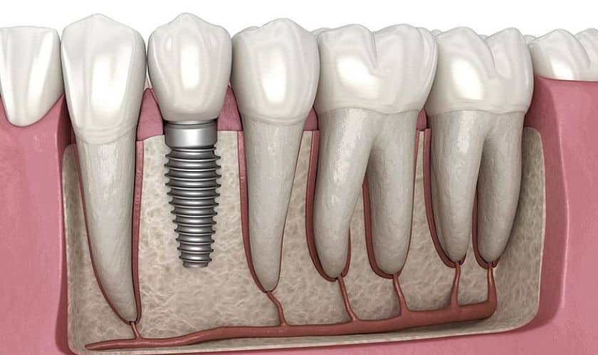 Early And Late Dental Implant Problems