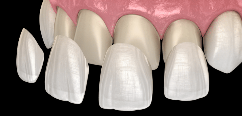 Guide to Dental Veneers