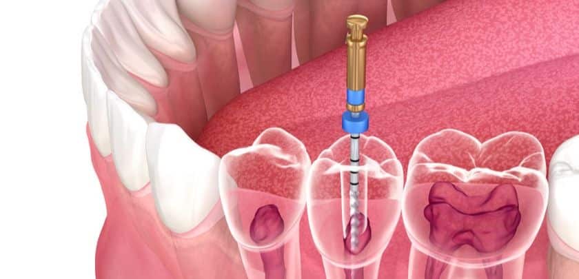 What to Do If a Root Canal Gets Infected