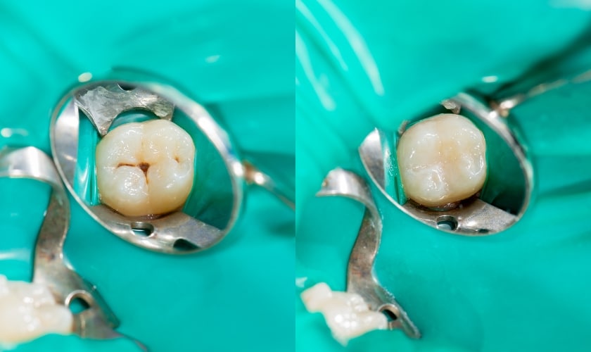 benefits of replacing your composite fillings