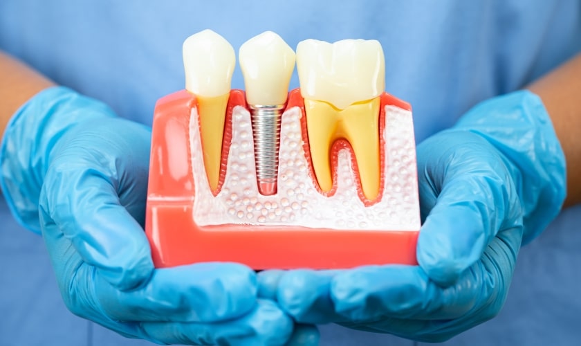 dental implants in gallatin