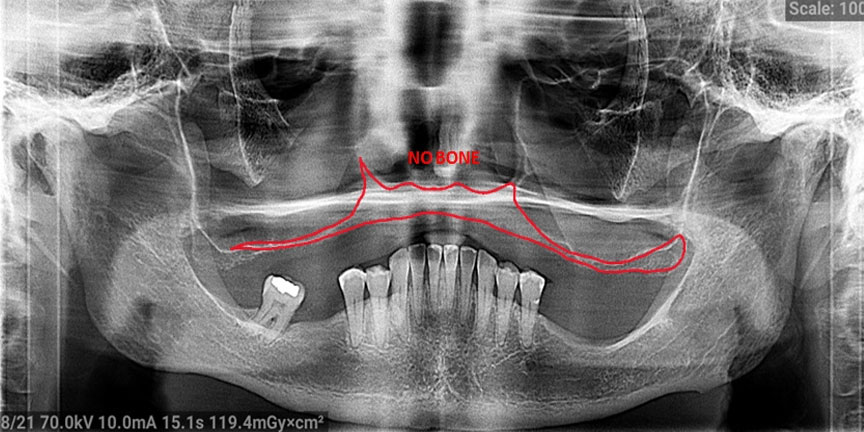 severe bone loss view