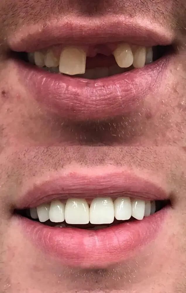 single tooth implant before after view