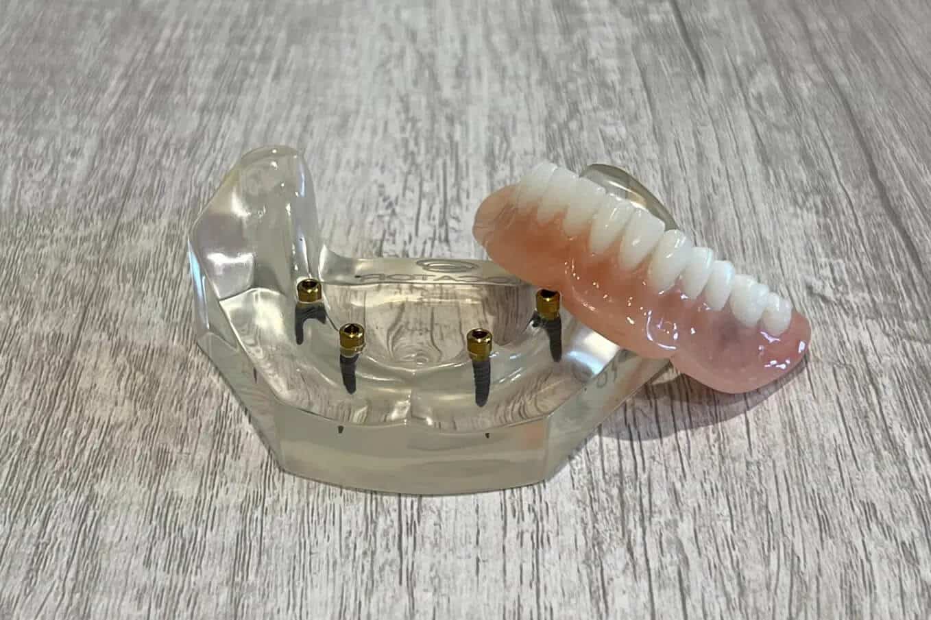 snap-in-implant-denture gallatin