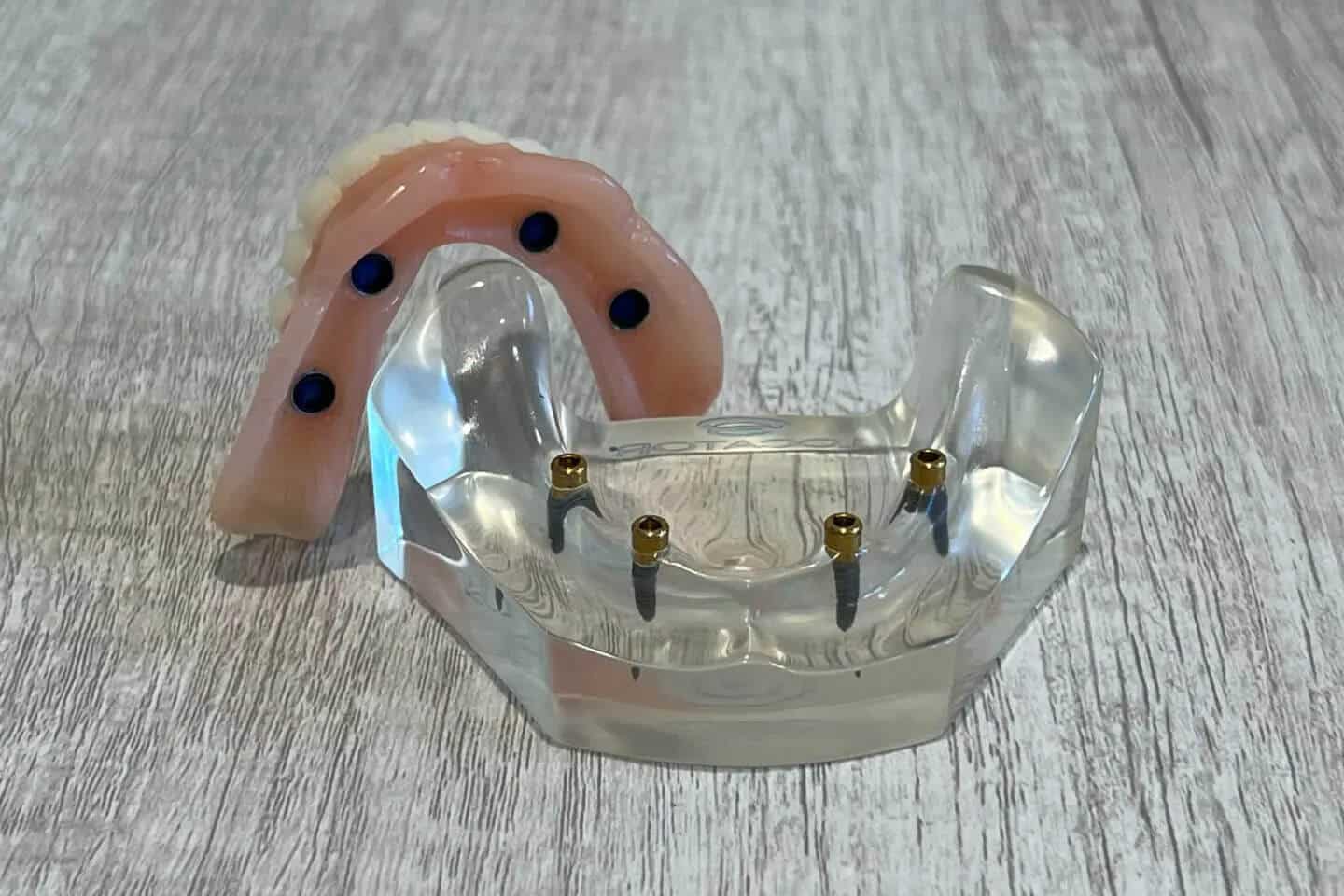 snap in implant denture