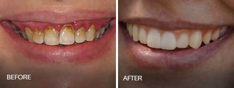before after view of the smile transformation by cosmetic dentistry at sumner dental group