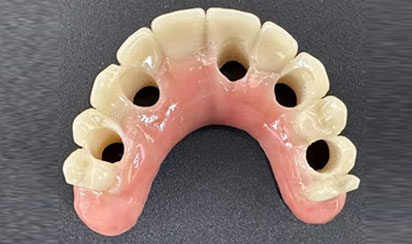 retrofitting implants