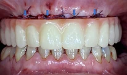 retrofitting tooth implants