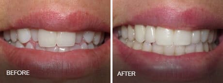 see the result of taking invisalign treatment at sumner dental group