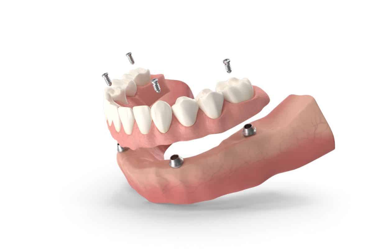 Featured image for “Are You a Candidate for All-On-4 Implants? Key Eligibility Factors”